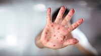 Health officials monitoring potential measles exposure in southwestern Utah
