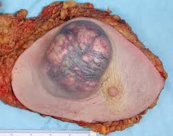 Image result for Breast cancer