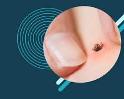 Image of person checking for ticks