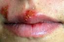 Herpes simplex virus - , the free encyclopedia