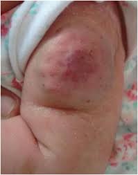 Rare Tumors in Children: Vascular Tumors | Springer Nature ...