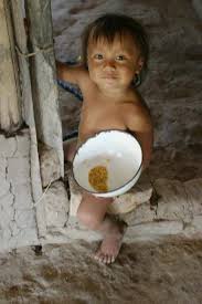 Resultado de imagem para crianças desnutridas