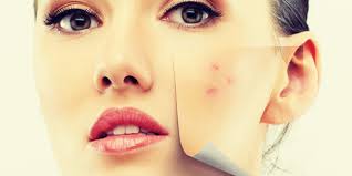 Image result for jerawat
