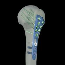 Alians Proximal Humerus - DBM Medical Group - Proximal Humerus