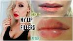 Lip fullers