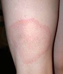 R�sultat de recherche d'images pour "maladie de lyme"