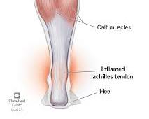 Image of Achilles tendonitis