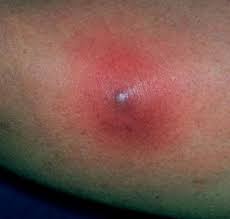 Image result for carbuncle