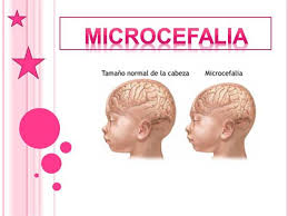 Resultado de imagem para microcefalia