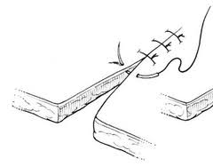 Image result for simple continuous suture pattern