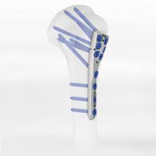 PHF Proximal humerus | Intrauma