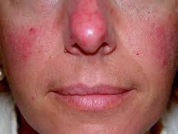 como quitar la rosacea de la cara