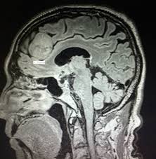 Newton-Wellesley Hospital's brain tumor investigation: New info on the 11 diagnosed nurses