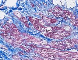 “Exploring the Link between Desmosomal Protein Degradation and Arrhythmogenic Cardiomyopathy”