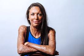 「turia pitt」の画像検索結果