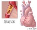 Koronare Herzkrankheit - was ist das? TK