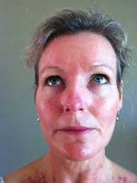 Heather Ellis. Edudex image. Day 1 - Monday, 10/9/2012. Age = 48 years. (Efudix applied to face twice daily). I&#39;m nervous as I know what my face will soon ... - efudix_face1