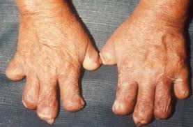 Image result for picture of leprosy