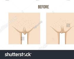 Image of Labioplastie before and after