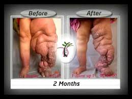 Image result for filariasis meaning