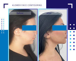 نتائج إبر إذابة الدهون الذقن قبل وبعد الرياض, AI generated