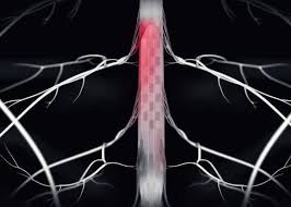 Major Breakthrough in Parkinson’s Disease Treatment: Neuroprosthesis Allows Restoration of Mobility