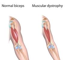 Image of Muscular dystrophy muscle