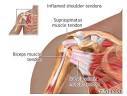 Upper trapezius pain icd 9