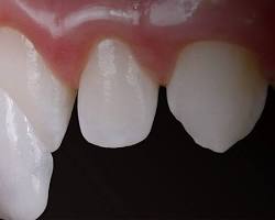 Image of Veneer sứ nha khoa