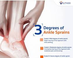 Image of Grade 3 ankle sprain