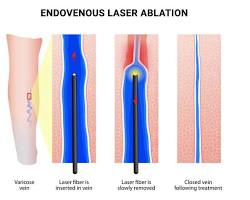 Image of Endovenous Laser Ablation (EVLA) for varicose veins