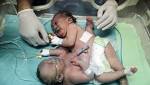 separated Gaza twin dies, sister