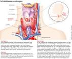 Schilddrüsenkrebs - was die Krankheit bedeutet