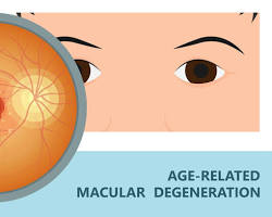 Image of Agerelated macular degeneration (AMD)