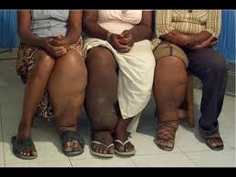 Image result for filariasis meaning