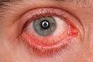 MIOS retina - Maladies traites - Inflammation oculaire et uvite