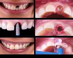 کاشت دندان در یک روز