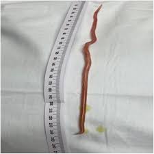 Bilious Worm Emesis Secondary to Intestinal Helminthic ...