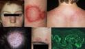 Lupus erythematodes: Therapie von SLE