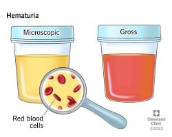 Image of Gross Hematuria