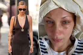 Bella Hadid tearfully shares ‘severe isolation and depression’ battle as chronic illness flares up