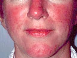 Resultado de imagen para Rosacea