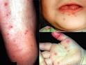 Coxsackie virus with rash