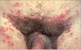 Image result for folliculitis