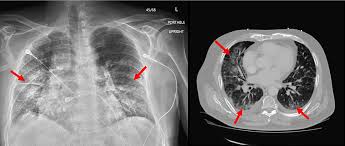 

A Case Study of Acute Respiratory Distress Syndrome After Radiofrequency Ablation for Atrial Fibrillation