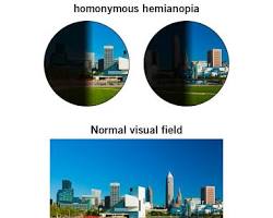 Homonim hemianopsi nedir?