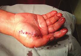 Image result for bomb explosion trauma surgery