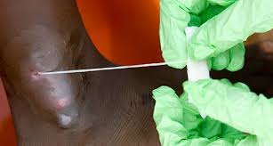 무서운이야기 - [약혐]숙주를 조정하는 기생충( 메디나충 ) : images?q=tbn:ANd9GcReh9mYmenGYwRwRsHwd0gSBt8P0MN90zdbCfVm-glE3YxGWIfN-Q