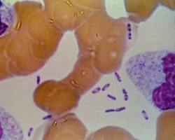 Image of bubonic plague diagnostic methods