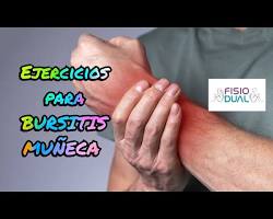 Imagen de Bursitis de muñeca